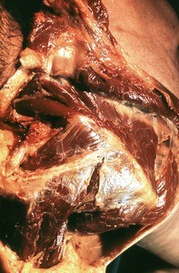 Natural color photograph of dissection of the left shoulder, posterosuperior view, with the trapezius muscle removed to expose the underlying muscles of the shoulder and back