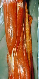 Natural color photograph of dissection of the right arm, anterior view, showing the antecubital fossa and associated structures