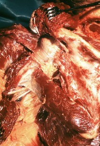Natural color photograph of dissection of the left shoulder, posterior view, showing the posterior muscles of the shoulder