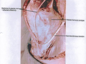 Natural color photgraph of right knee, anteromedial view, showing muscles, tendon and bone with Sartorius and Gracilis muscles retracted