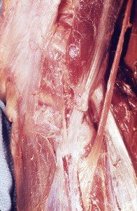 Natural color photograph of dissection of the right knee, medial view, showing muscles and tendons