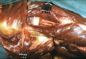 Natural color photograph of dissection of the left shoulder, lateral view, with the deltoid and pectoralis major reflected to expose the muscle structure of the upper arm and shoulder