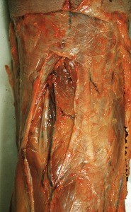 Natural color photograph of the popliteal fossa, showing initial incision