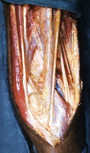 Natural color photograph of dissection of the popliteal fossa