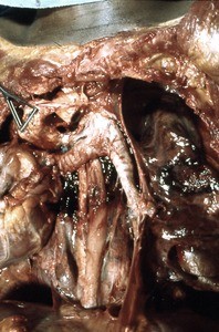 Natural color photograph of dissection of the thorax, anterior view, with the heart removed to expose the trachea and esophagus with a penetrating wound