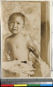 Child burn victim treated at hospital, Haizhou, China, 1916