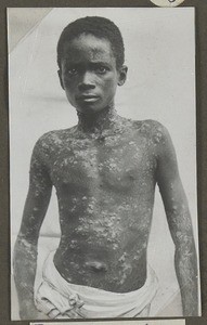 Yaws, Tanzania, ca.1929-1940
