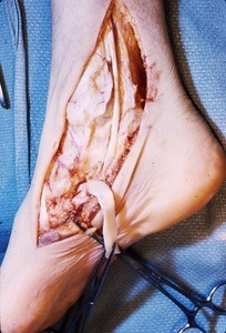 Natural color photograph of dissection of the right ankle, medial view, with the tibialis posterior t. cut and reflected