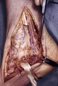 Natural color photograph of dissection of the right ankle, medial view, emphasizing the tibial nerve