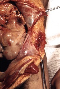 Natural color photograph of dissection of the abdomen, anterior view, showing the internal organs of the lower left quadrant