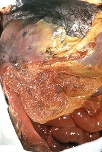 Natural color photograph of dissection of the right upper quadrant of the abdomen, anterior view, with the anterior wall removed to reveal the liver, greater omentum, and small intestines