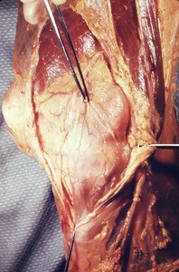 Natural color photograph of dissection of the right knee, anterior view
