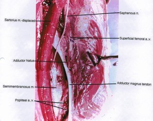 Natural color photograph of left thigh, anteromedial view showing muscles, arteries, veins, tendon and Adductor hiatus