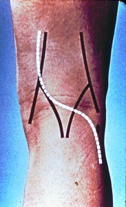 Illustration of surface anatomy of right knee, posterior, with lines indicating outline of popliteal fossa as well as head of fibula; white dashed lines indicate incision to expose popliteal fossa's contents
