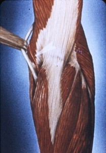 Illustration of right elbow joint, posterior view, with ulnar nerve retracted with forceps; large white arrowhead indicates ulnar artery