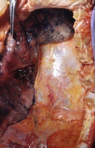 Natural color photograph of dissection of thorax, anterior view, with the left ribs and most of the left lung removed to expose the posterior wall of the thorax