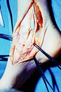 Natural color photograph of dissection of the right ankle, medial view, exposing the tibialis posterior t. and the flexor digitorum longus t