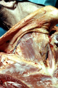 Natural color photograph of dissection of the right side of the neck, inferoanterior view, with the skin reflected to expose the sternocleidomastoid muscle