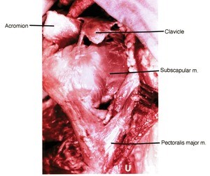 Natural color photograph of dissection of the right shoulder, superoanterior view, showing bone and muscle structure