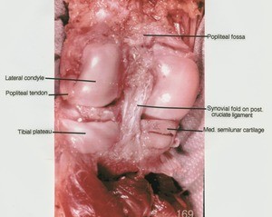 Natural color photograph of left knee, posterior view, showing bones, tendon, meniscus and ligament