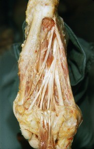 Natural color photograph of deep dissection of the plantar surface of the left foot