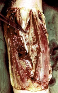 Natural color photograph of dissection of the forearm, anterior view