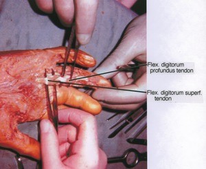 Natural color photograph of dissection of the palmer surface of the right hand, showing flexor digitorum profundus and superficialis tendons