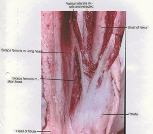 Natural color photograph of the knee, anterior view, the musculature has been retracted to display the femur