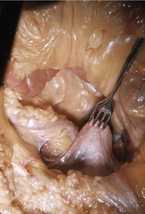 Natural color photograph of dissection of the pelvic cavity, superior view, with the uterus retracted posteriorly to expose the vesicouterine pouch