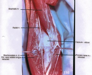 Natural color photograph of right lower arm and upper forearm, anterior view, showing elbow joint capsule, muscles and course of Radial nerve with the Brachioradialis, Extensor carpi radialis lingus and Pronator teres muscles retracted