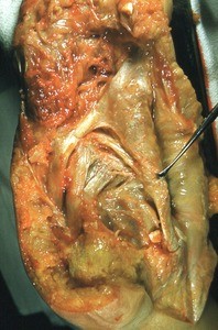 Natural color photograph of dissection of the plantar surface of the left foot