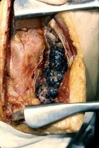 Natural color photograph of dissection of the left thorax, anterior view, with the ribs retracted to expose the mediastinum and lung
