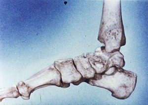 Illustration of articulated bones (tarsal and metatarsals) of right foot from medial aspect (includes tibia)