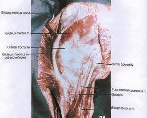 Natural color photograph of dissection of the right upper leg and hip, lateral view