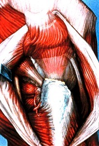 Illustratration of right hip, lateral view, with gluteus maximus m. divided vertically and retracted, gluteus medius m. cut from its insertion and reflected superiorly to expose gluteus minimus m; also shown: piriformis m., sup. & inf. gemelli mm., obturator internus m., quadratus femoris m.,semitendinosus m., vastus lateralis m.; sciatic n., inf. gluteal a.; dashed line indicates insertion of gluteus minimus m. on greater trochanter of femur