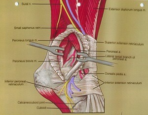 Illustration of dissection of the right ankle, lateral view, showing the lateral tarsal artery, with the peroneus longus muscle and peroneus brevis muscle retracted