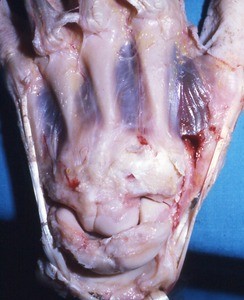 Natural color photograph of dissection of the dorsal surface of the left hand, exposing the carpal bones