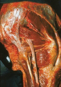 Natural color photograph of dissection of the right gluteal region, showing nerves and musculature