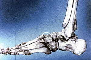 Illustration of bones of left ankle and foot, lateral view