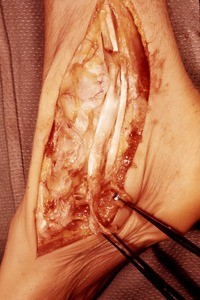 Natural color photograph of dissection of the right ankle, medial view, with the tibialis posterior t. and the flexor digitorum longus t. cut