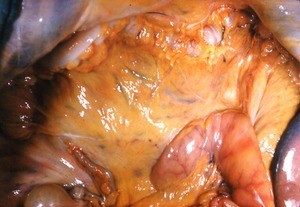 Natural color photograph of dissection of the peritoneal cavity, anterior view, showing abdominal viscera and associated mesentery