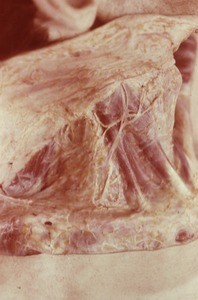 Natural color photograph of dissection of the right side of the neck, lateral view, showing nerves and muscles