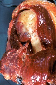 Natural color photograph of dissection of the right shoulder, lateral view, with the deltoid muscle retracted to expose the muscles of the rotator cuff, axillary nerve, and surgical neck of the humerus