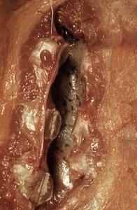 Natural color photograph of dissection of the thorax, with the skin and superficial musculature removed and ribs cut to expose lung tissue