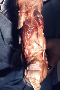 Natural color photograph of dissection of the right foot, posterior view, showing the subtalar joint, with the calcaneal tendon cut and reflected