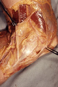 Natural color photograph of dissection of the left knee, medial view, showing muscles, tendons and superficial vessels