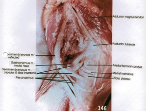 Natural color photograph of left knee, medial view, showing muscles, tendons, bones, medial meniscus and insertions of Semimembranosus muscle