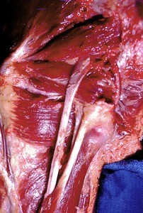 Natural color photograph of dissection of the left gluteal region, showing nerves and musculature