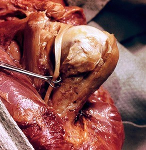 Natural color photograph of dissection of the left shoulder, anterior view, with the deltoid muscle reflected and fibrous capsule of the glenohumeral joint removed to expose the tendon of the long head of the biceps brachii muscle