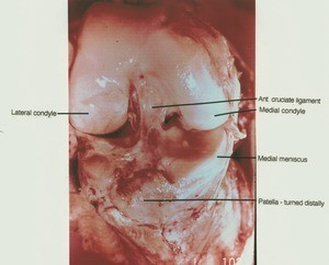 Natural color photograph of right knee, anterior view, showing bones, ligaments and menisci